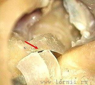 Рис. 5. Укладка фрагментов аутохряща над электродом. Примечание: (красная стрелка)  полоски аутохряща.