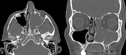 КТ-снимки пациента с первичной инвертированной папилломой полости носа