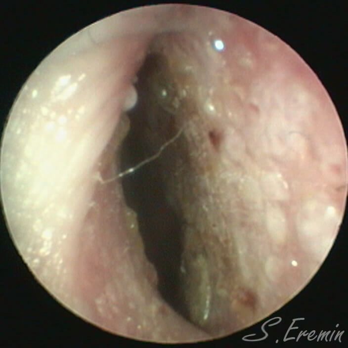 вход в нос сужен искривлением перегородки так сильно, что нельзя пройти эндоскопом