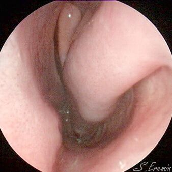 нормальная перегородка носа - искривления незначительны