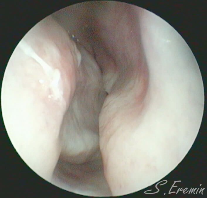 выраженный гребень перегородки носа 2