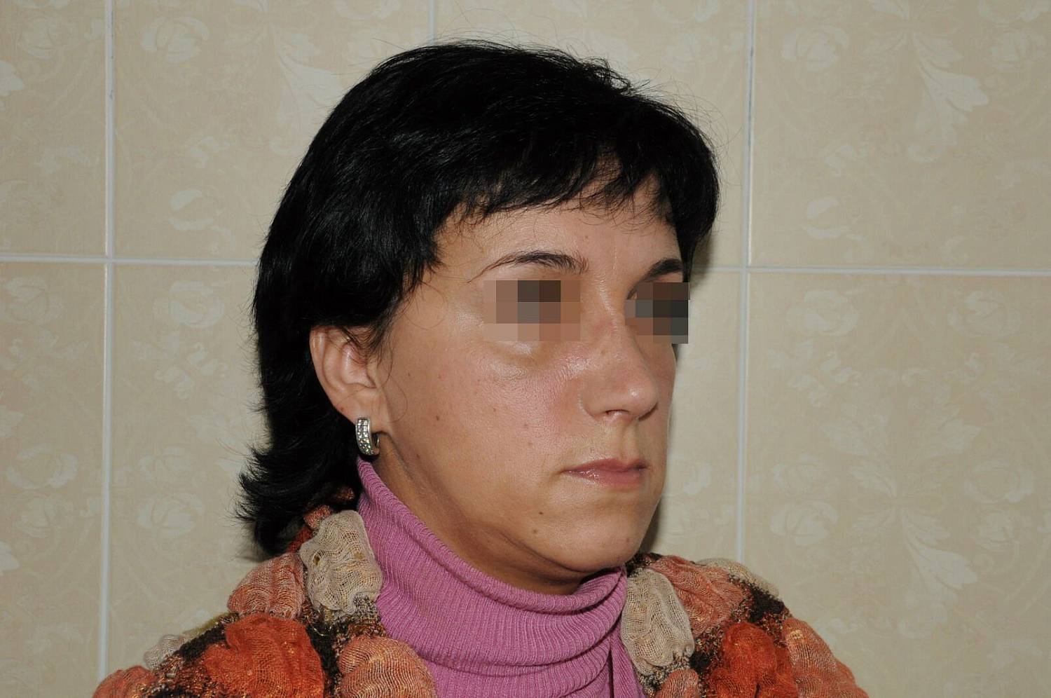 После операции